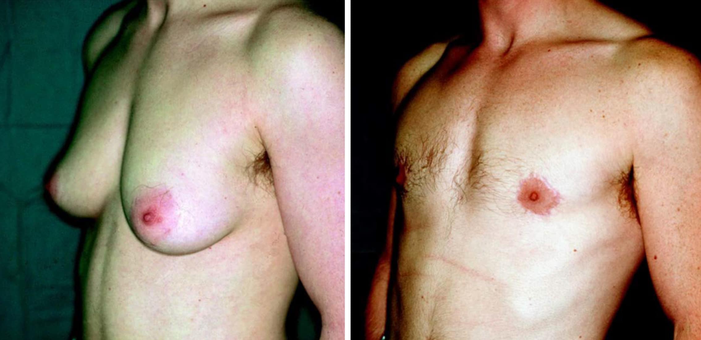 Mastectomy Before After