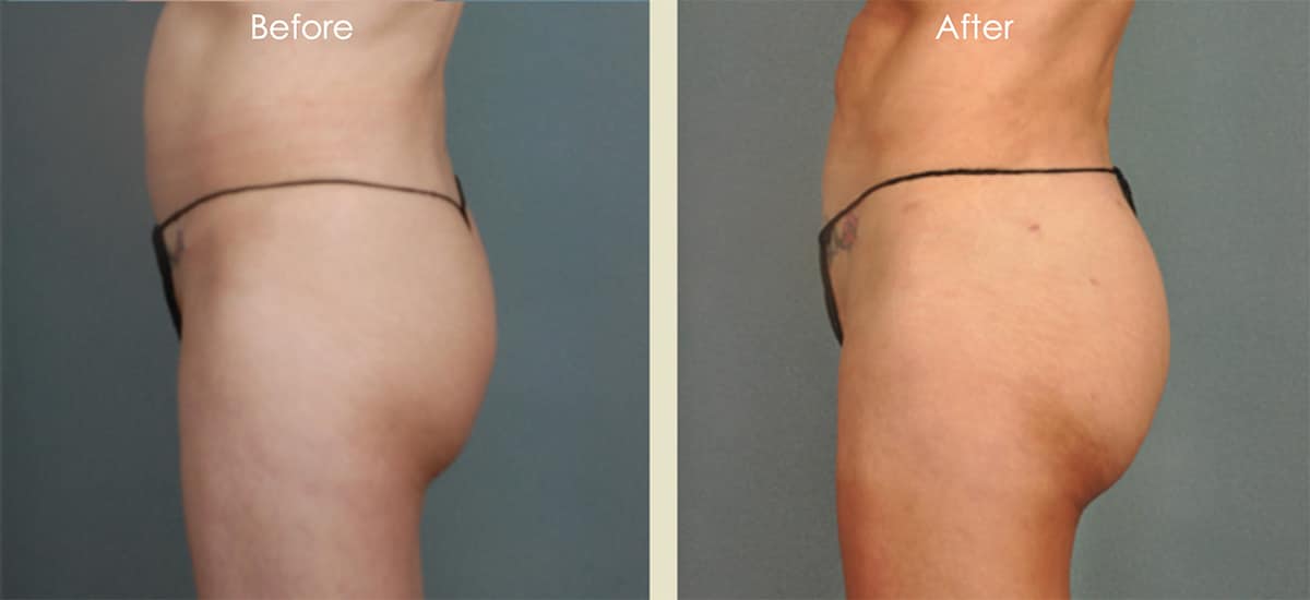Brazilian Butt Lift - Before and After - Kelamis Plastic Surgery