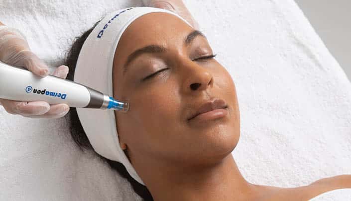Microneedling with SkinPen