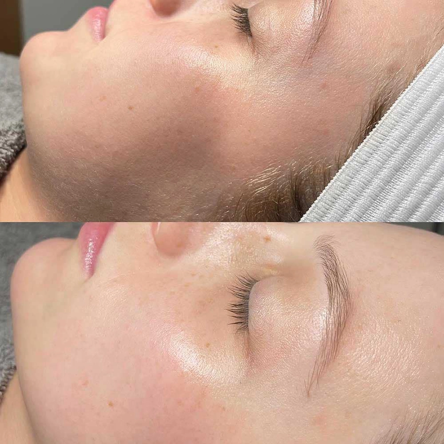 Dermaplaning before and after on a female