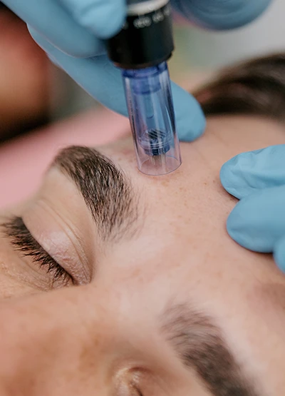 male patient receiving microneedling above eyebrow