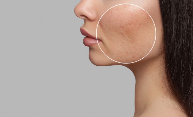Woman with acne scars on the cheek